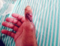 DESESPERO: PACIENTE DE MACHADINHO EST&Aacute; H&Agrave; 04 MESES AGUARDANDO CIRURGIA NO POLEGAR - Foto: ASSESSORIA