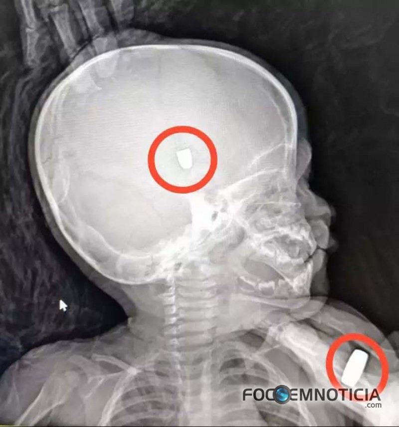 CRIAN&Ccedil;A DE UM ANO E CINCO MESES &Eacute; ATINGIDA NA CABE&Ccedil;A POR TIROS DE PISTOLA NO SETOR 09 EM ARIQUEMES